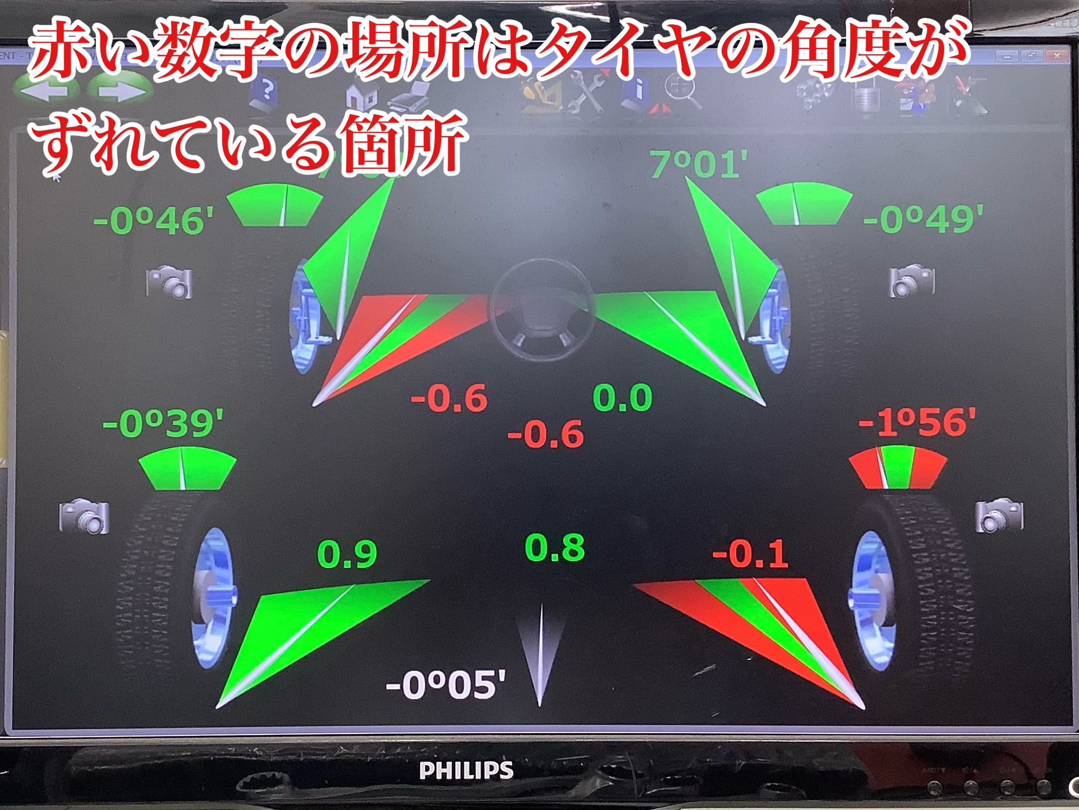 アライメント　クラウンアライメント